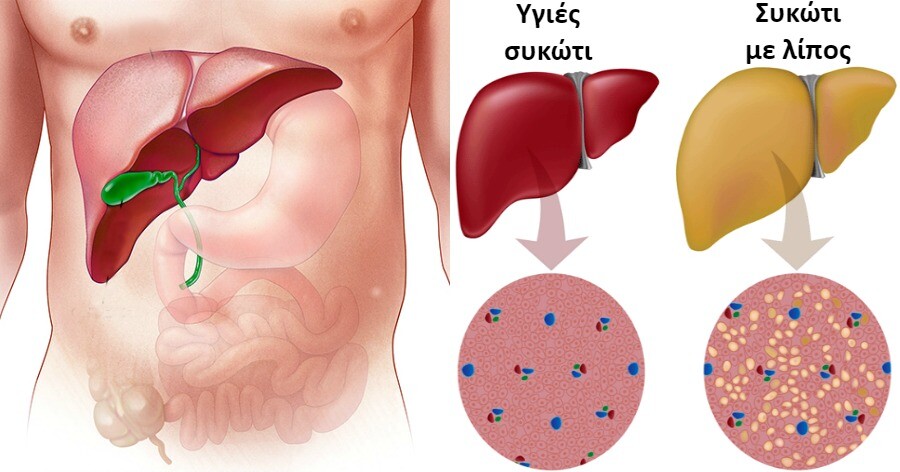 2 στους 5 Ανθρώπους έχουν Λίπος στο Συκώτι και Δεν το Γνωρίζουν. Ιδού 10 Φυσικοί Τρόποι για το Αποτοξινώσετε